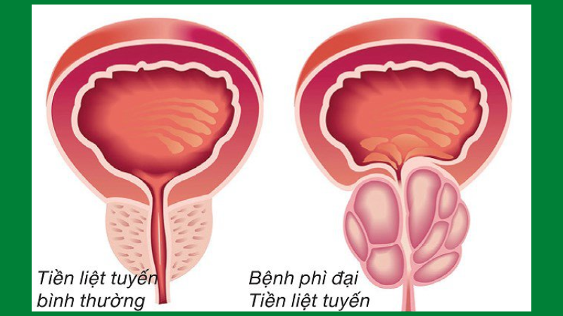 Cây dừa cạn chữa ung thư tuyến tiền liệt