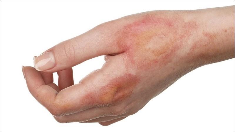 Cây dừa cạn có công dụng chữa bỏng nhẹ